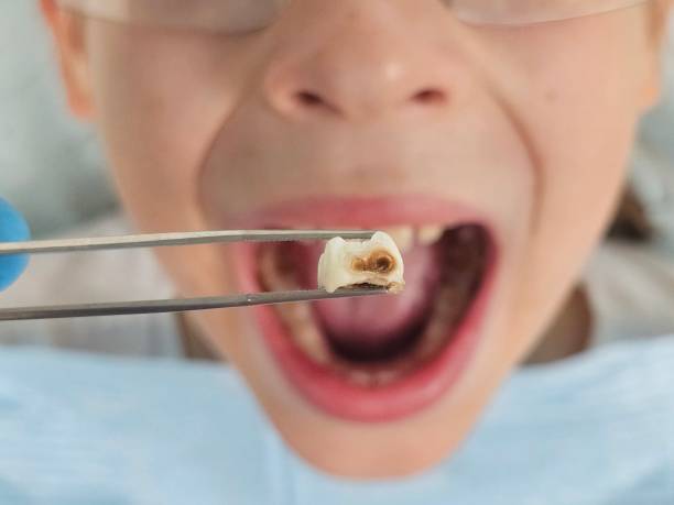 Best Emergency Wisdom Teeth Removal in Springfield, MO